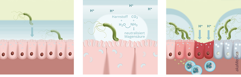 Infographic Helicobacter